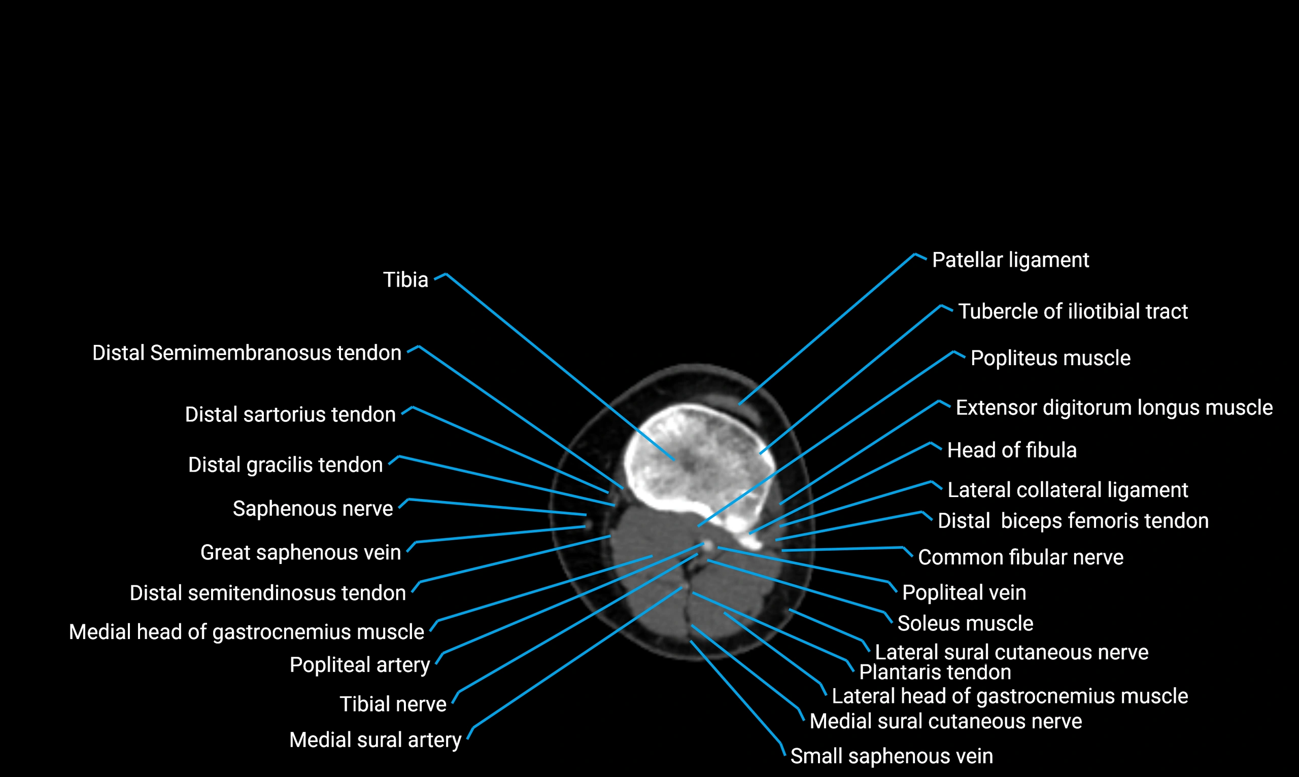 CT lower limb axial cross sectional anatomy labelled image 94 (2).webp
